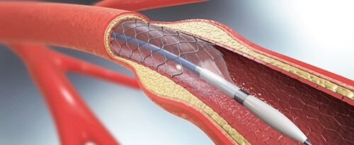 close-up of medical tube in vein graphic