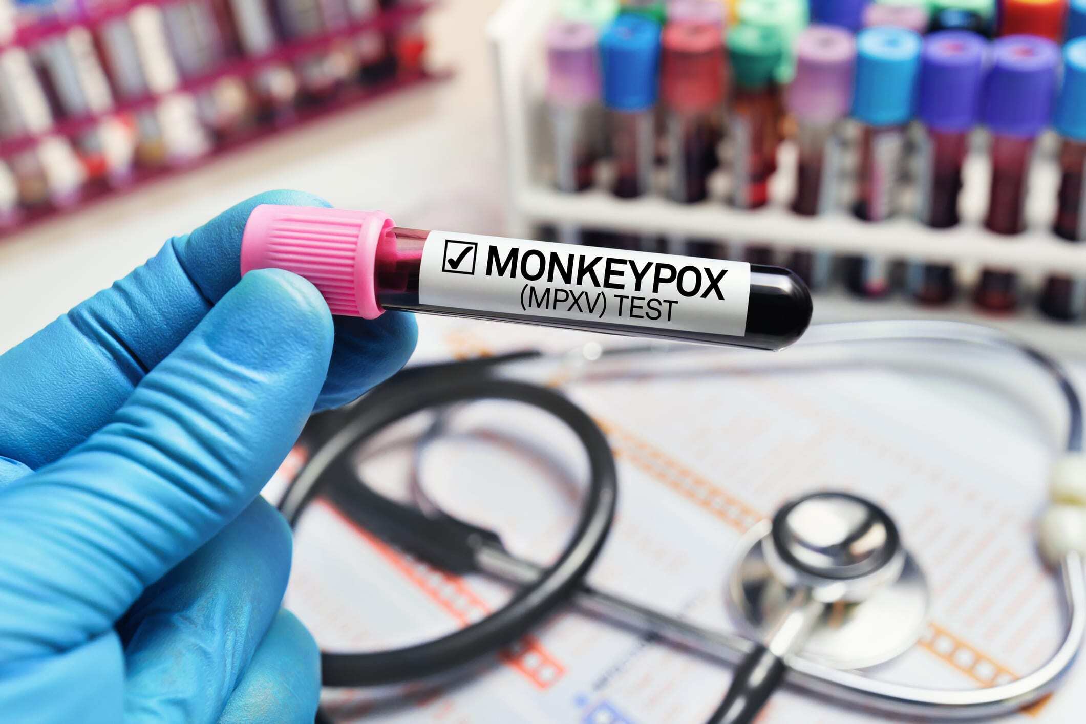 gloved hand holding monkeypox sample