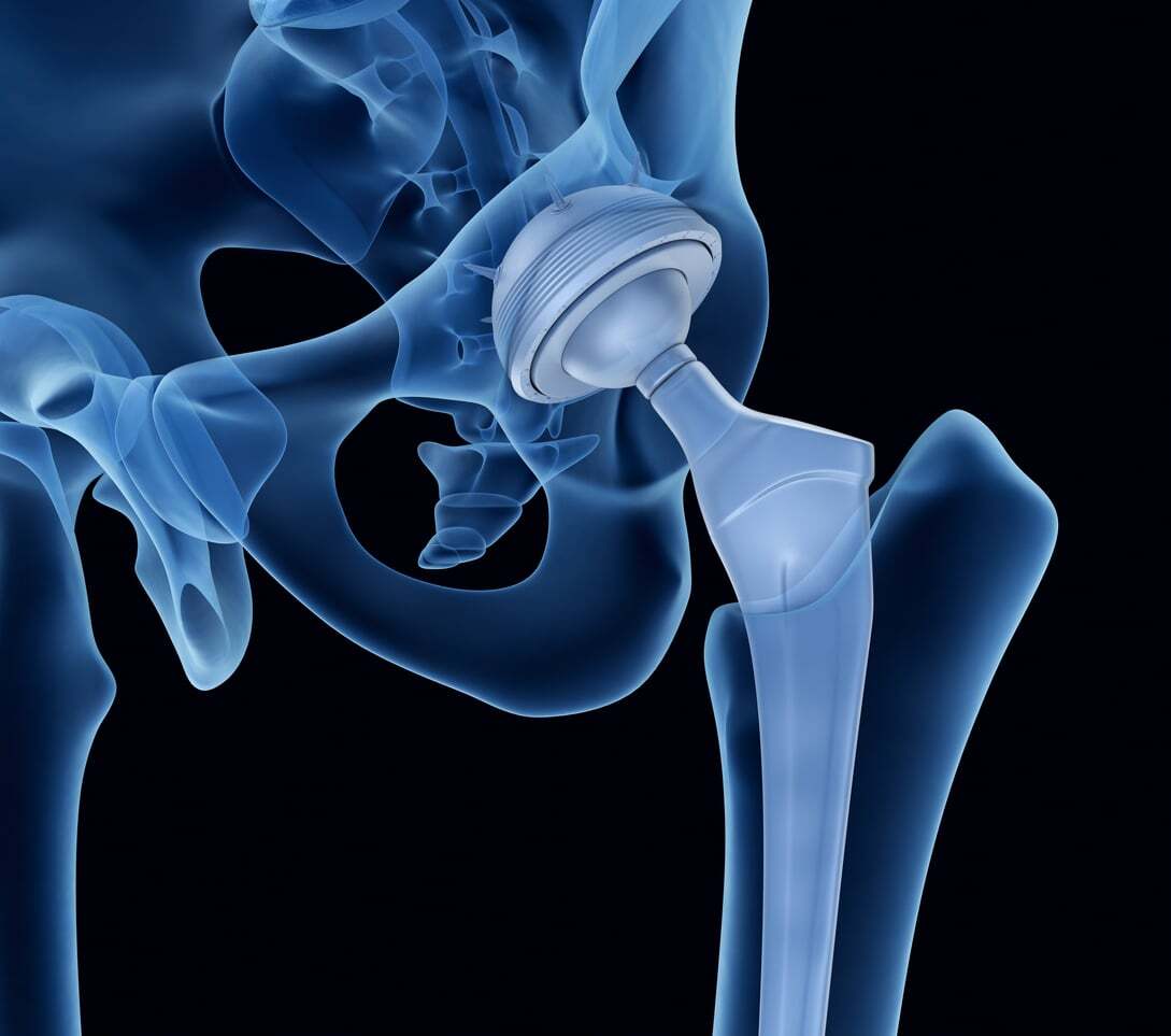hip replacement graphic