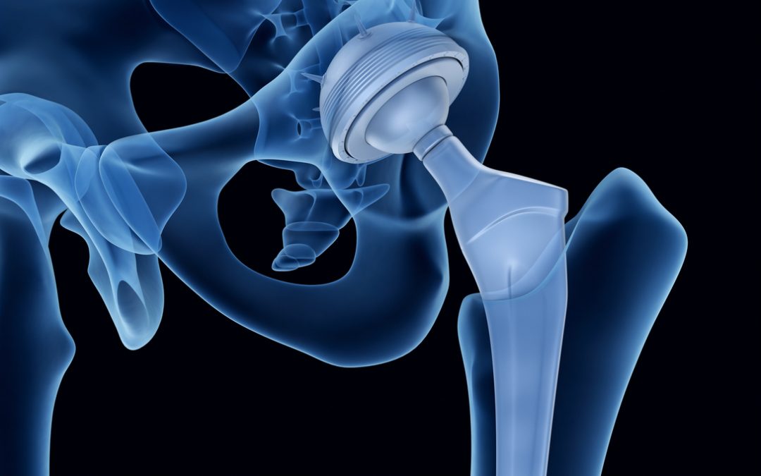 Metal Implants: FDA’s November, 2019 Immunology Devices Panel Meeting