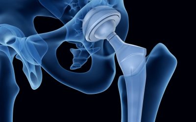 Metal Implants: FDA’s November, 2019 Immunology Devices Panel Meeting