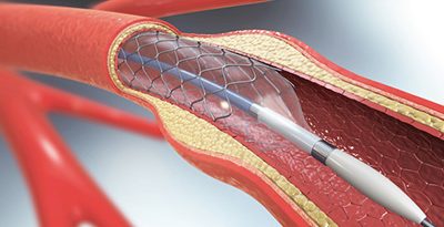 Coronary, Peripheral, and Neurovascular Guidewires – Performance Tests and Recommended Labeling